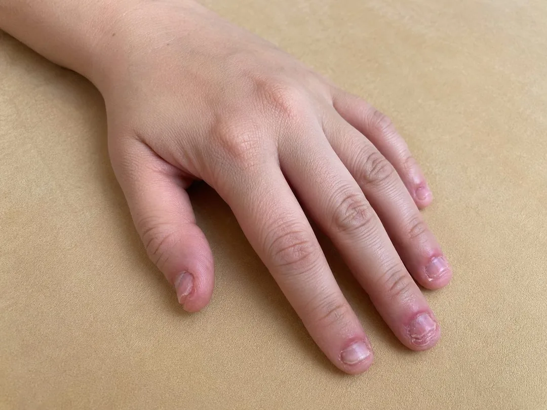 Bitten short nails with sore cuticles, before the protocol
