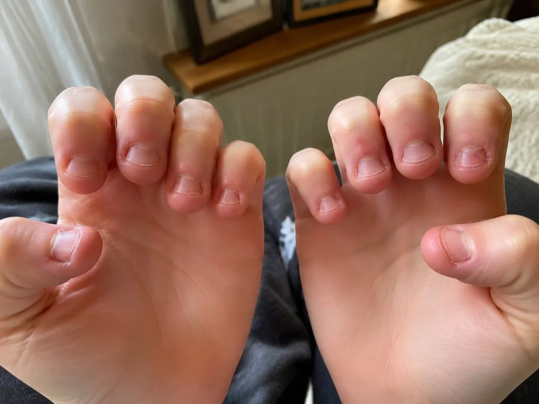 Close-up of a bitten nail and sore cuticle